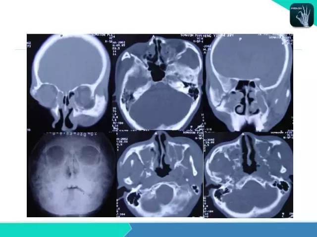 【PPT】鼻和鼻窦疾病影像学诊断