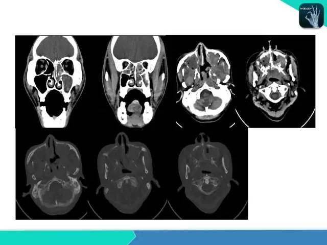 【PPT】鼻和鼻窦疾病影像学诊断