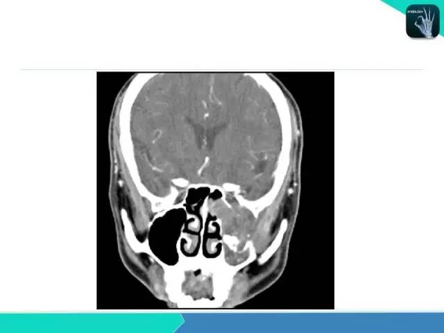 【PPT】鼻和鼻窦疾病影像学诊断
