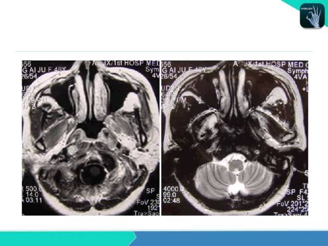 【PPT】鼻和鼻窦疾病影像学诊断