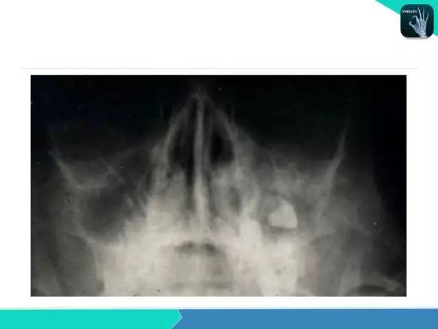 【PPT】鼻和鼻窦疾病影像学诊断