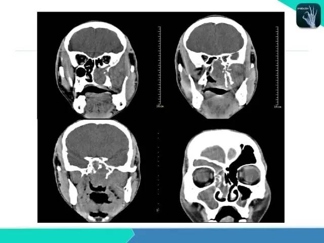 【PPT】鼻和鼻窦疾病影像学诊断