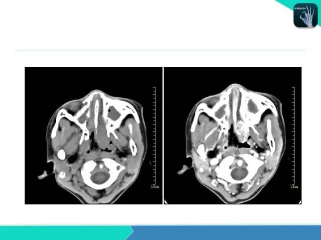【PPT】鼻和鼻窦疾病影像学诊断