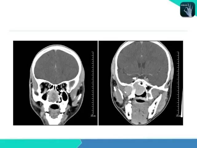 【PPT】鼻和鼻窦疾病影像学诊断