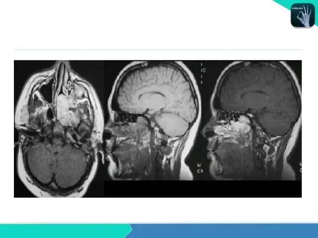 【PPT】鼻和鼻窦疾病影像学诊断