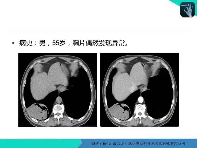 【病例】胸膜局限性纤维性肿瘤1例CT影像表现