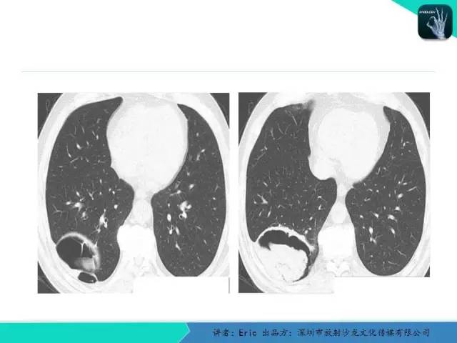 【病例】胸膜局限性纤维性肿瘤1例CT影像表现