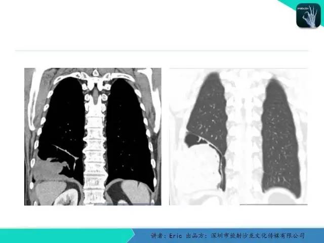 【病例】胸膜局限性纤维性肿瘤1例CT影像表现