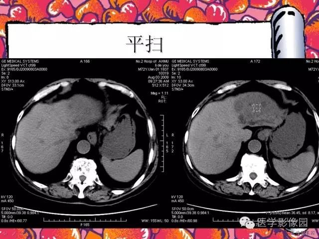 【病例】纤维肉芽肿型肝脓肿1例CT影像表现 【病例】纤维肉芽肿型肝脓肿1例CT影像表现