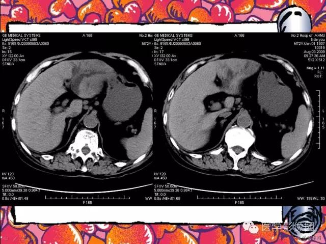 【病例】纤维肉芽肿型肝脓肿1例CT影像表现 【病例】纤维肉芽肿型肝脓肿1例CT影像表现
