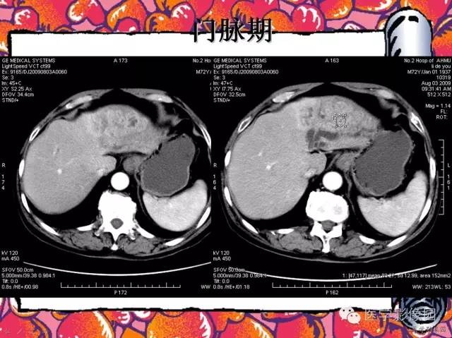 【病例】纤维肉芽肿型肝脓肿1例CT影像表现 【病例】纤维肉芽肿型肝脓肿1例CT影像表现
