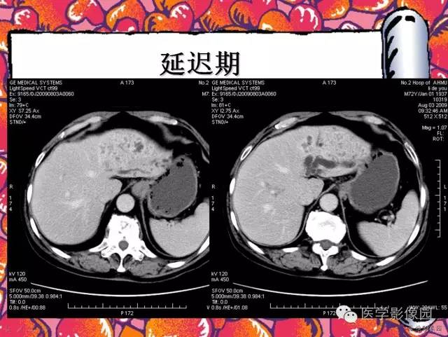 【病例】纤维肉芽肿型肝脓肿1例CT影像表现 【病例】纤维肉芽肿型肝脓肿1例CT影像表现