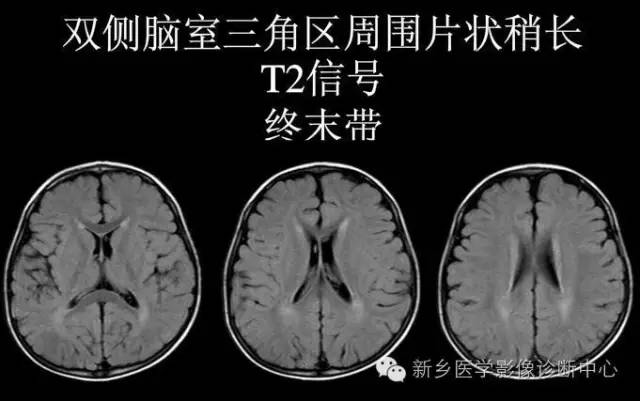 再次认识“终末带”，别再误会是髓鞘化延迟哦