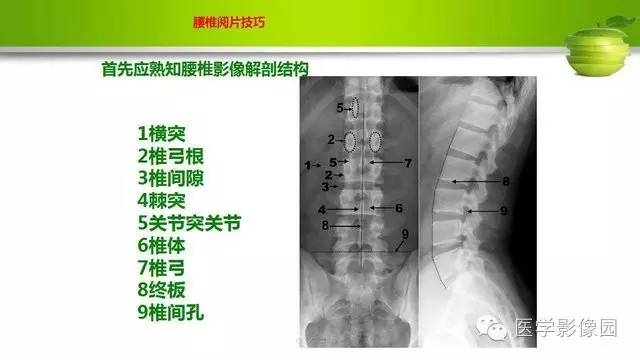 【PPT】腰椎阅片技巧