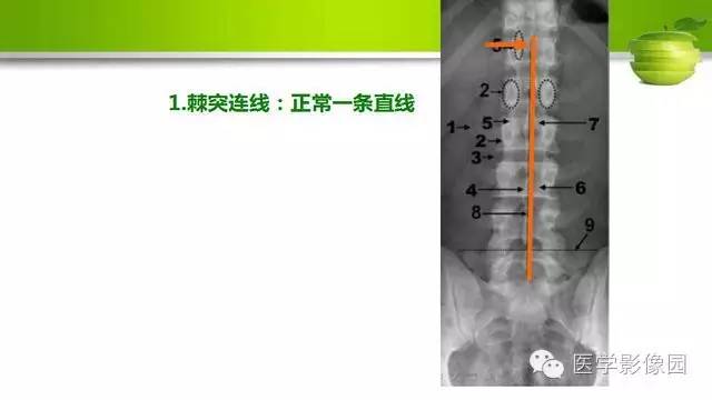 【PPT】腰椎阅片技巧