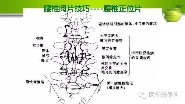 【PPT】腰椎阅片技巧