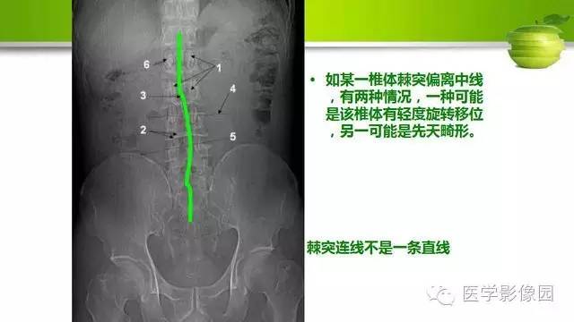 【PPT】腰椎阅片技巧