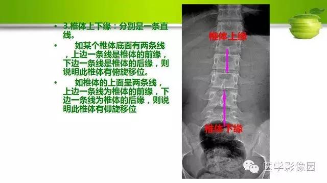 【PPT】腰椎阅片技巧