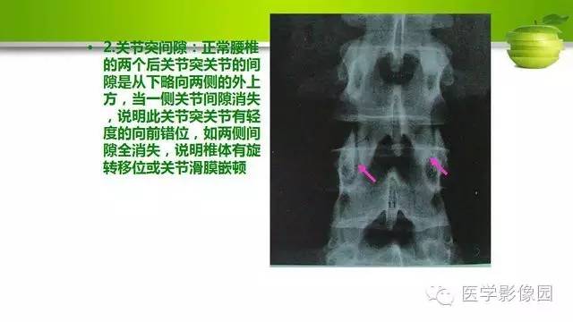 【PPT】腰椎阅片技巧