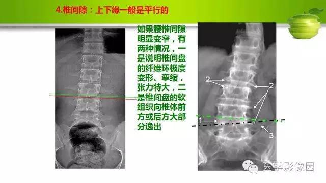 【PPT】腰椎阅片技巧