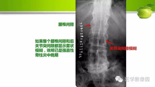 【PPT】腰椎阅片技巧
