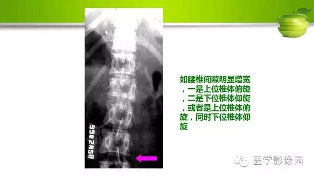 【PPT】腰椎阅片技巧