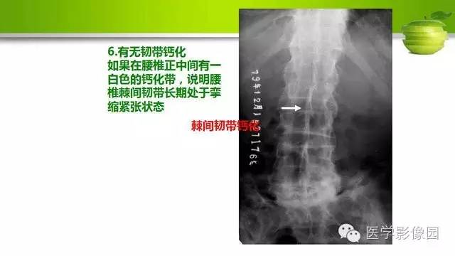 【PPT】腰椎阅片技巧