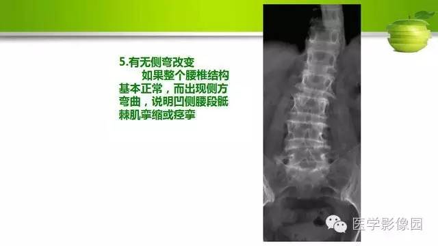 【PPT】腰椎阅片技巧