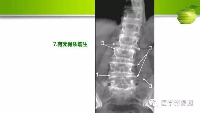 【PPT】腰椎阅片技巧