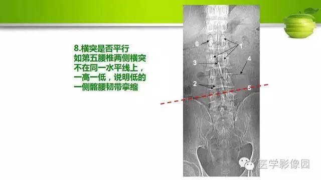 【PPT】腰椎阅片技巧