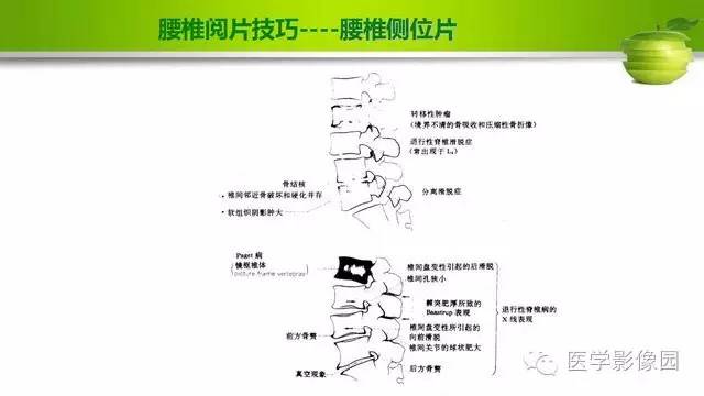 【PPT】腰椎阅片技巧
