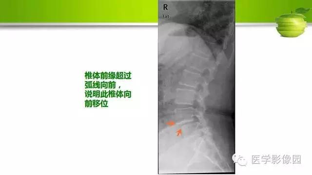 【PPT】腰椎阅片技巧