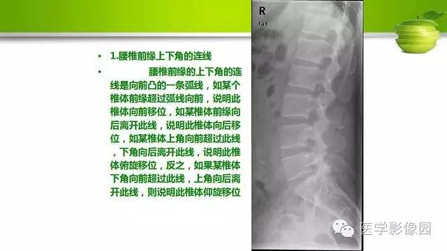 【PPT】腰椎阅片技巧