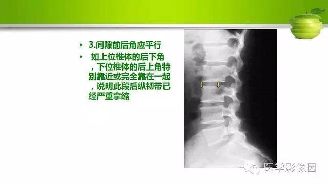 【PPT】腰椎阅片技巧