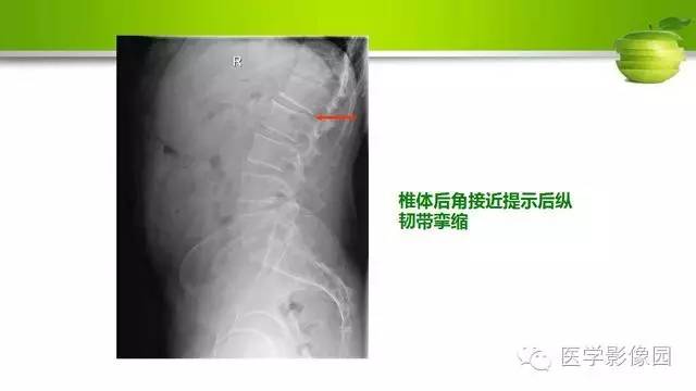【PPT】腰椎阅片技巧