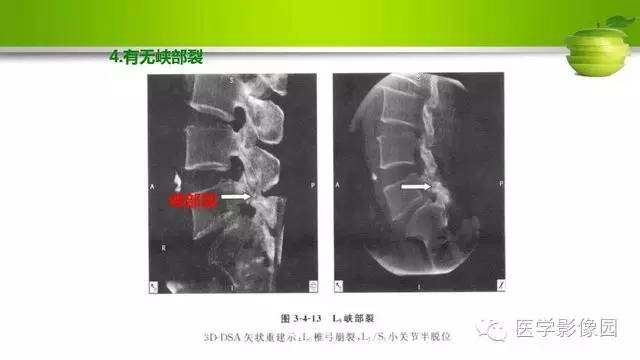 【PPT】腰椎阅片技巧