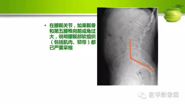 【PPT】腰椎阅片技巧