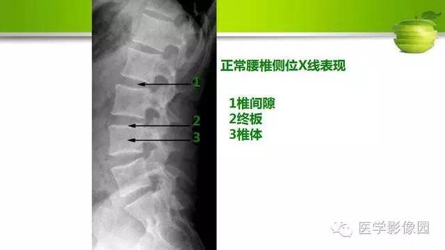 【PPT】腰椎阅片技巧