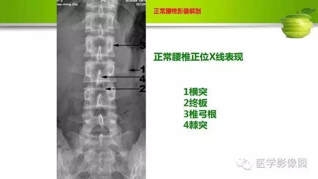 【PPT】腰椎阅片技巧