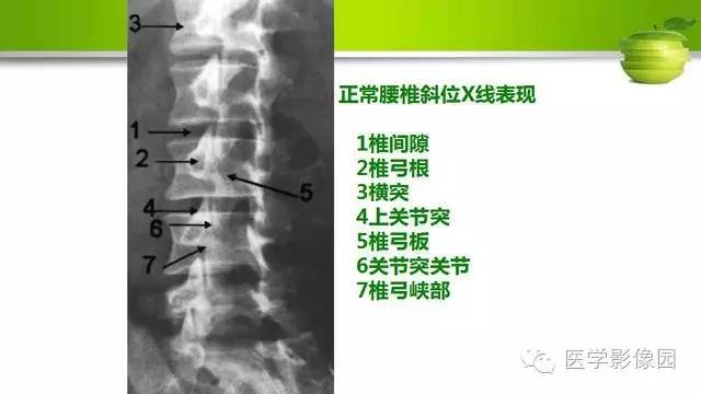 【PPT】腰椎阅片技巧