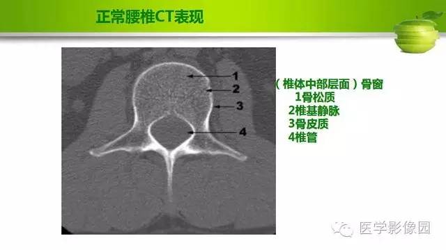 【PPT】腰椎阅片技巧