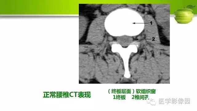 【PPT】腰椎阅片技巧