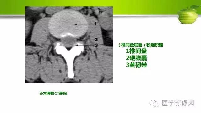 【PPT】腰椎阅片技巧