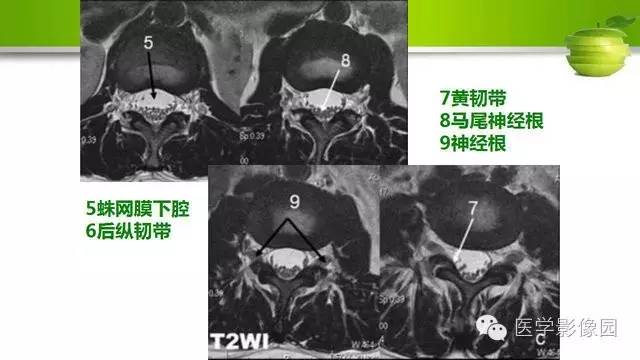 【PPT】腰椎阅片技巧