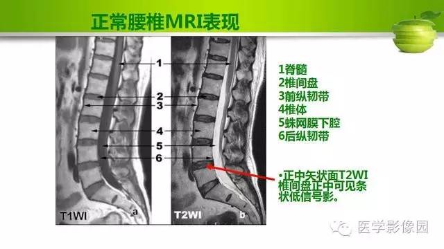 【PPT】腰椎阅片技巧