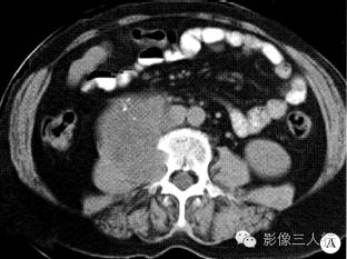 【病例】腹膜后神经鞘瘤1例CT影像表现