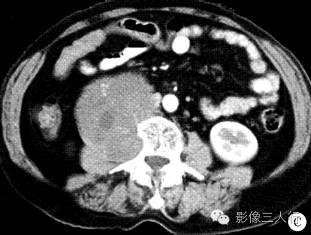 【病例】腹膜后神经鞘瘤1例CT影像表现 【病例】腹膜后神经鞘瘤1例CT影像表现