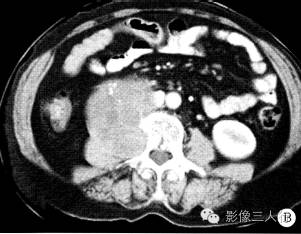 【病例】腹膜后神经鞘瘤1例CT影像表现 【病例】腹膜后神经鞘瘤1例CT影像表现