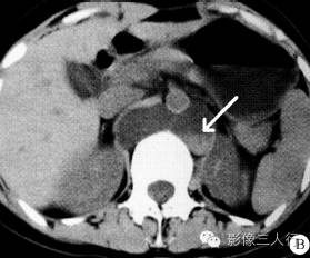 【病例】腹膜后区囊性淋巴管瘤伴出血1例CT影像表现 【病例】腹膜后区囊性淋巴管瘤伴出血1例CT影像表现