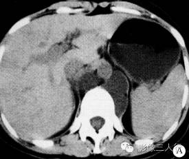 【病例】腹膜后区囊性淋巴管瘤伴出血1例CT影像表现